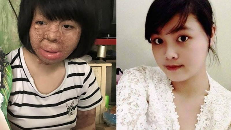 Co gai bi chong thieu song chia se ve khat vong song hinh anh