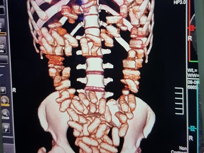 Co gai ngoai quoc nuot... 1,26 kg cocain vao bung hinh anh