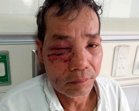 Lam tac phuc kich nem da can bo kiem lam trong thuong hinh anh