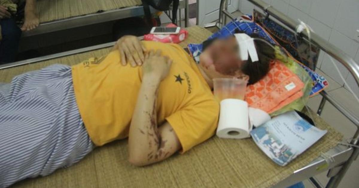 Gia canh eo le cua nu phu bep bi tat axit bong mat, hong mot ben mat hinh anh