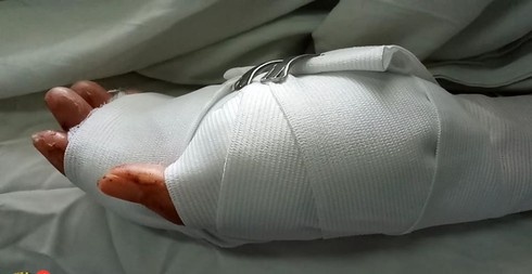 Ngoi trong nha, 1 phu nu bi nhom thanh nien xong vao chem dut ngon tay hinh anh