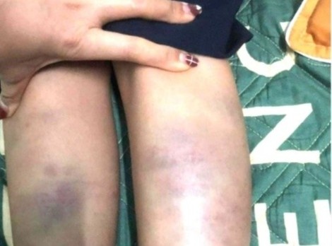 Vi sao khong khoi to hinh su vu hoc sinh lop 1 bi bam tim chan tay? hinh anh