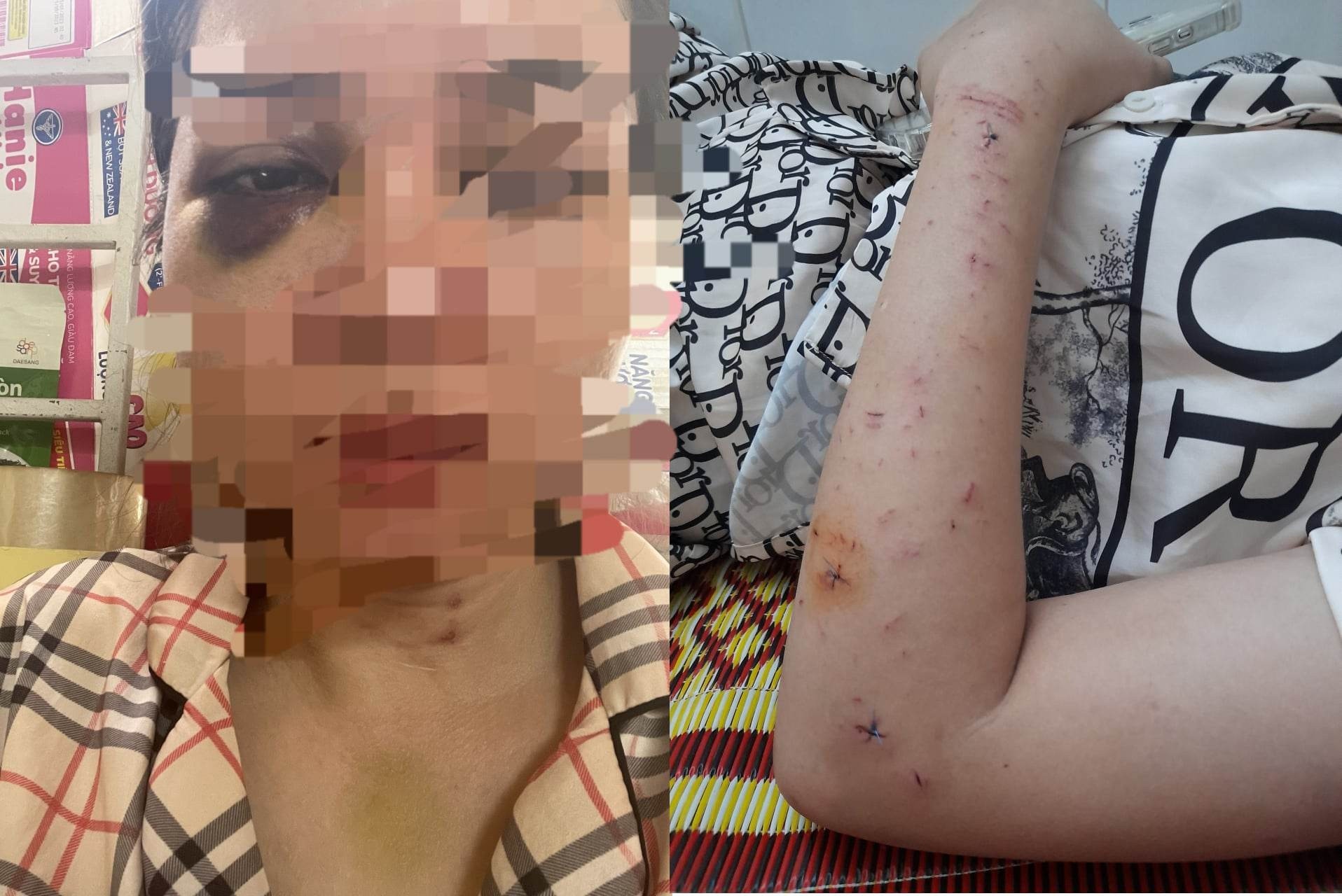 Nguoi phu nu bi chong cu danh nhap vien truoc ngay sinh nhat hinh anh