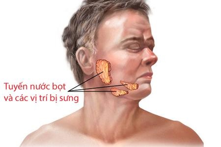 Dau hieu mac quai bi hinh anh