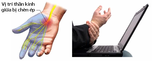 Bệnh hay gặp ở người làm báo ảnh 1 Benh hay gap o nguoi lam bao anh 1