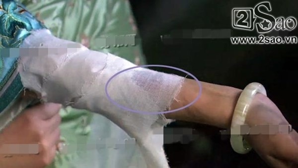 Vết thương của nhân vật Mi Trang đã được băng kín.