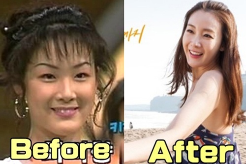 Lo anh Choi Ji Woo chua phau thuat tham my nam 19 tuoi hinh anh