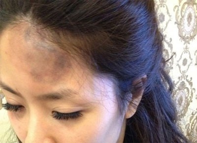 Ảnh nạn nhân bị Hồng Quế và Quế Vân