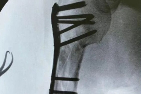 Lam Chi Dinh duoc dong 10 chiec dinh vao tay phai hinh anh