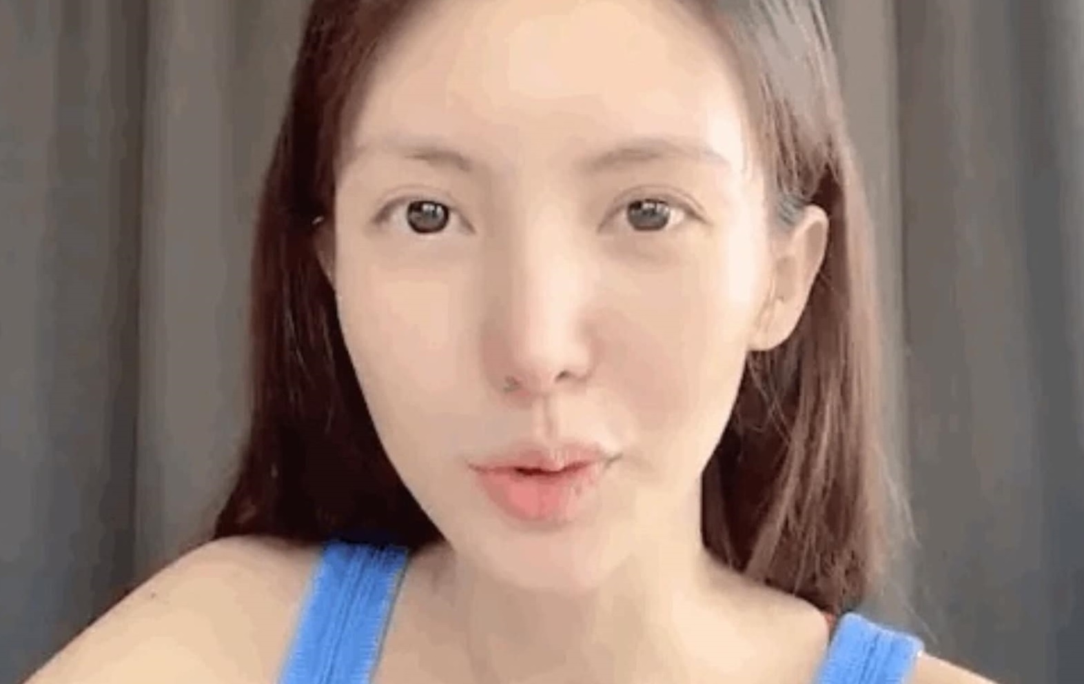 Kim Than bi lech mieng vi phau thuat tham my qua da hinh anh