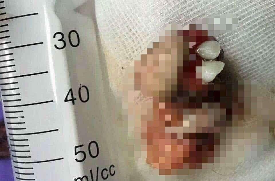 Khoi u moc rang trong buong trung be gai 12 tuoi hinh anh