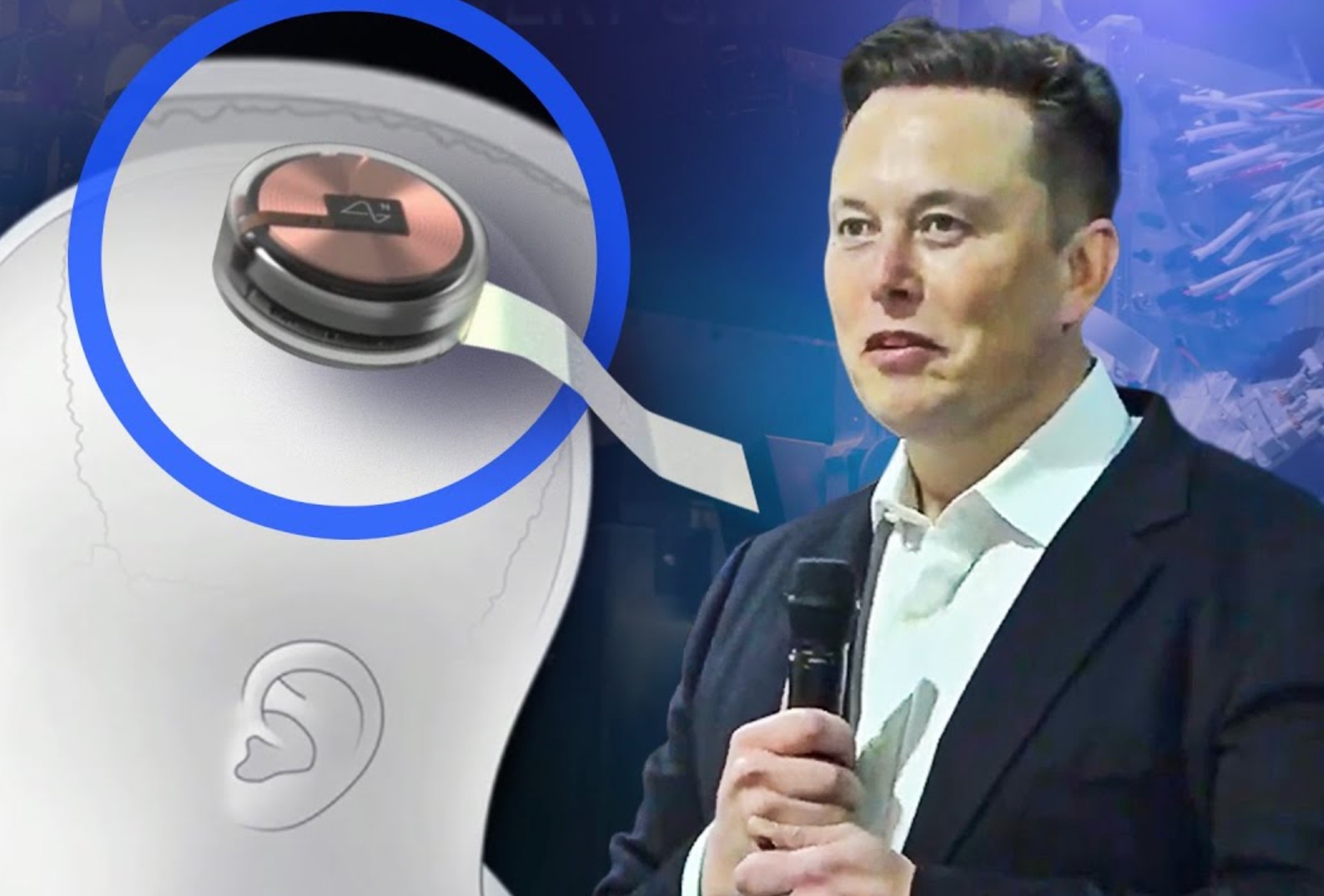 Elon Musk cay chip vao nao de chua cho nguoi mu, bai liet hinh anh