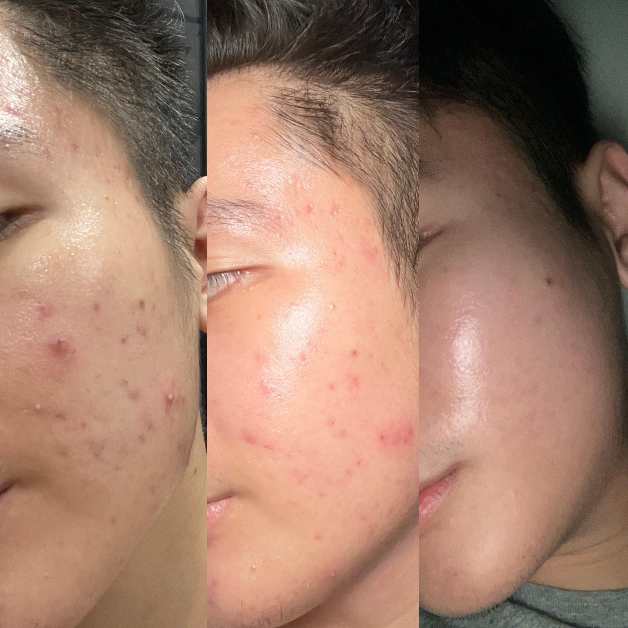 chua mun cho nam gioi anh 2