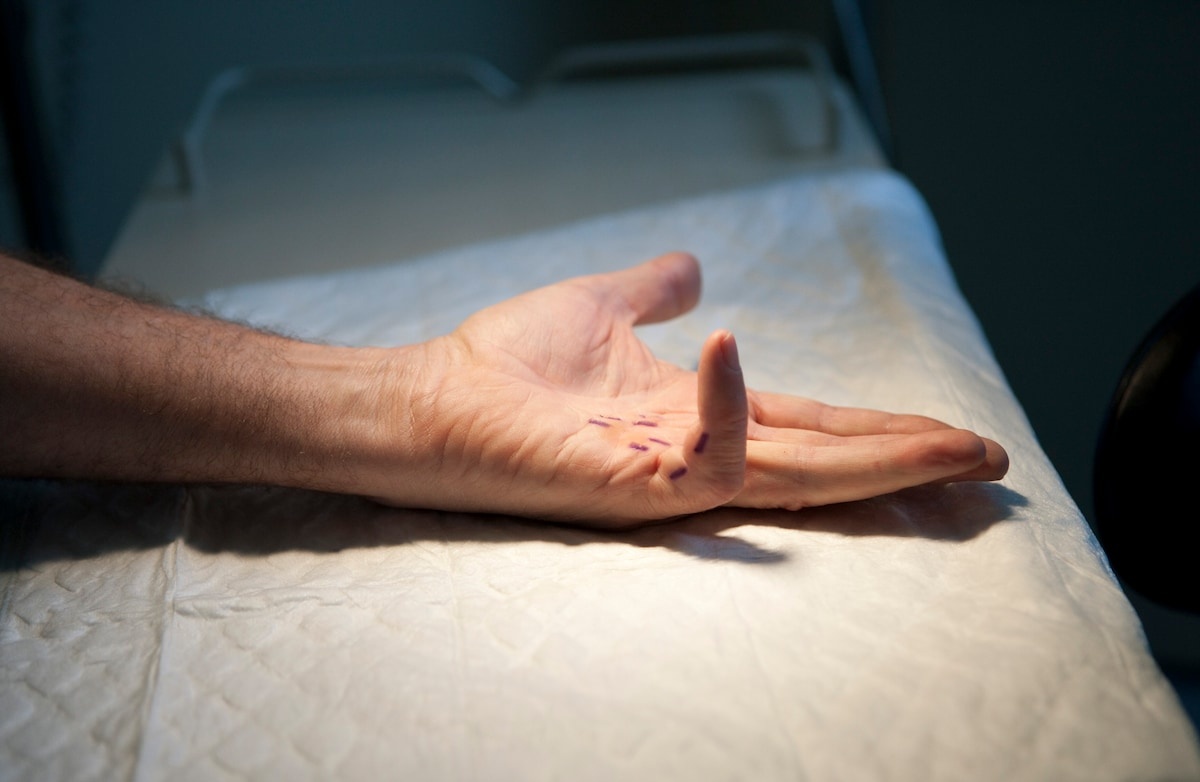 benh khien ngon tay cong anh 1