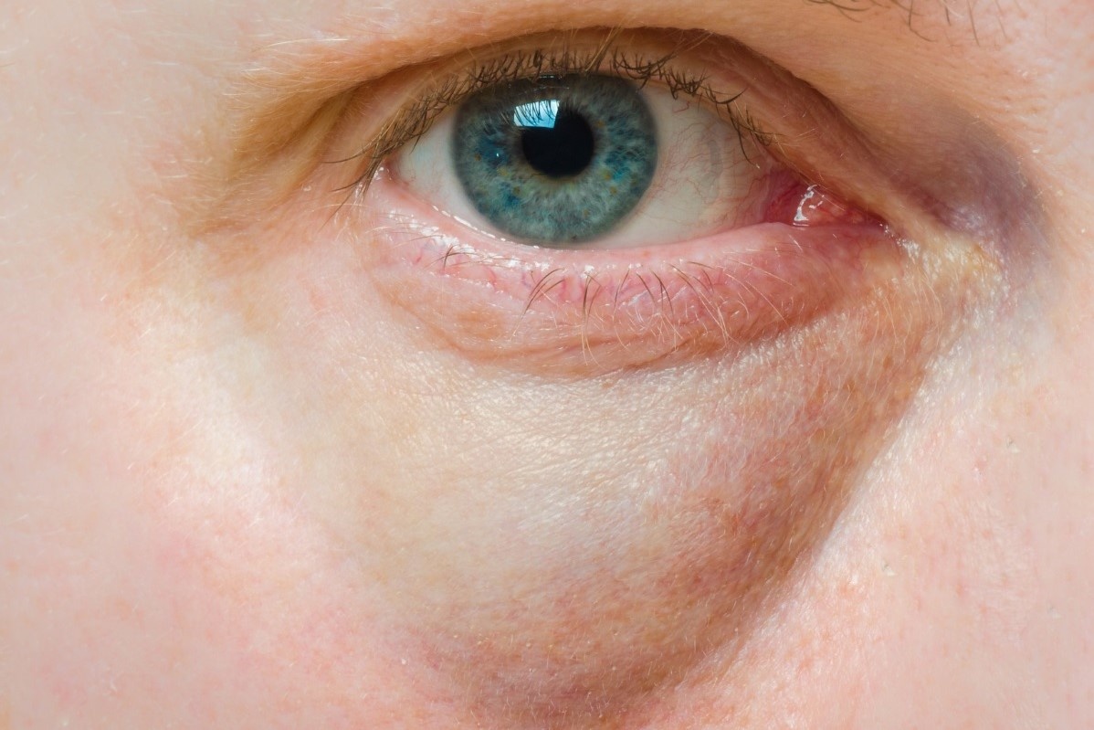 Dau hieu gan nhiem mo tren khuon mat hinh anh