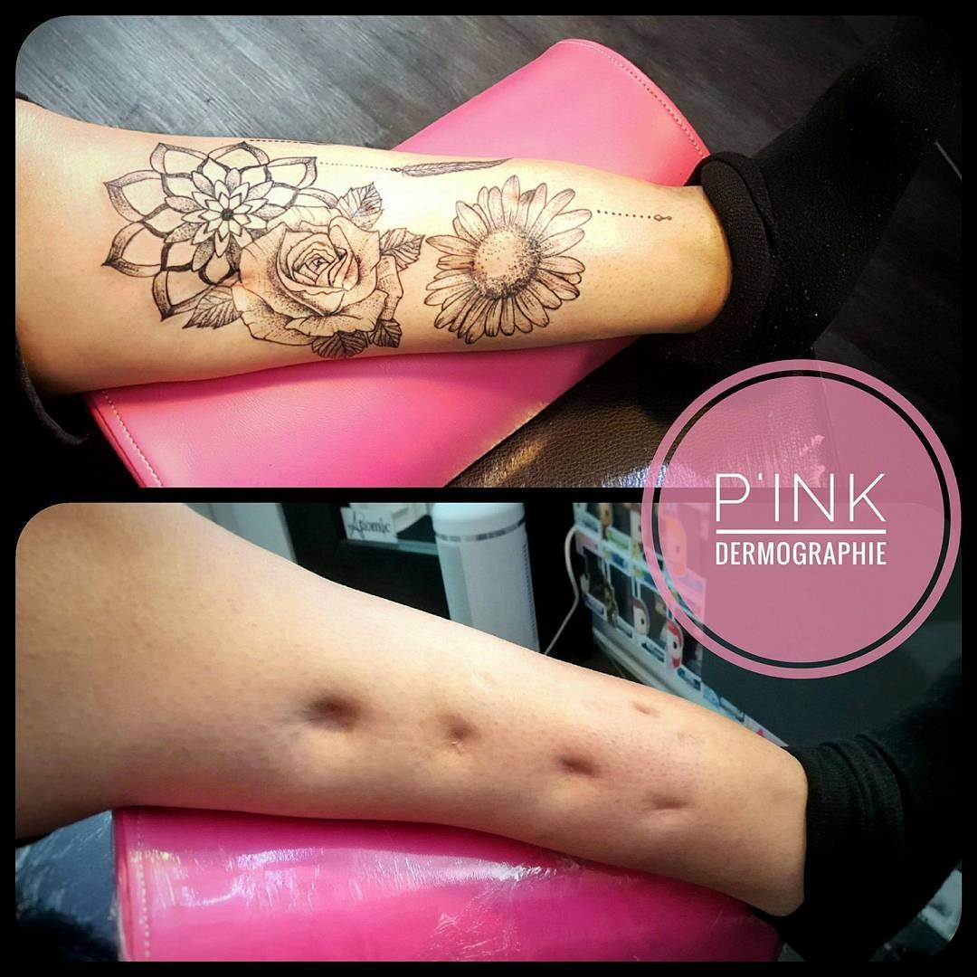 biến vết sẹo thành hình xăm ảnh 1 bien vet seo thanh hinh xam anh 1