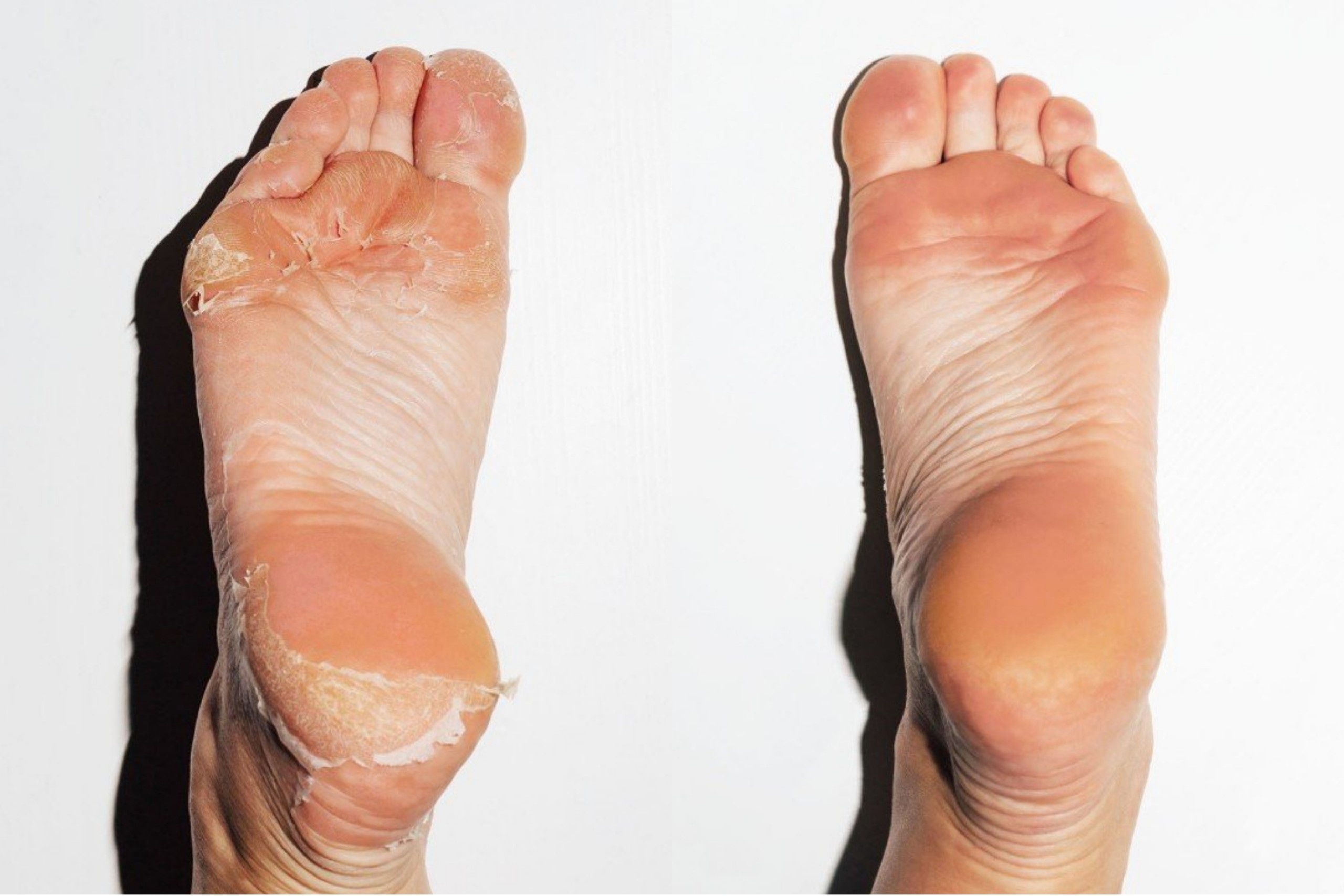 8 cach chua nut ne got chan tai nha hinh anh