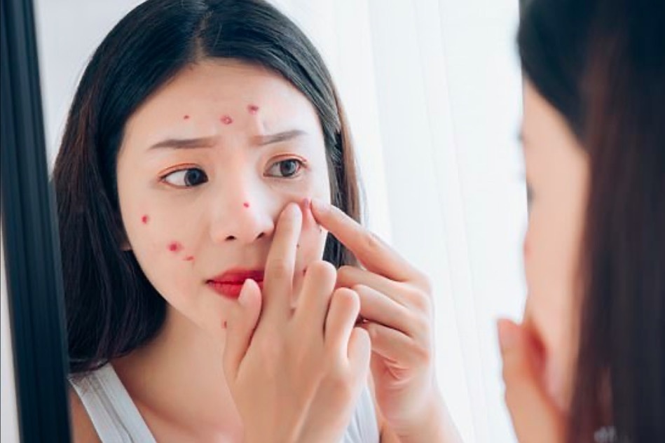 Vi sao da co mun du chi o nha? hinh anh