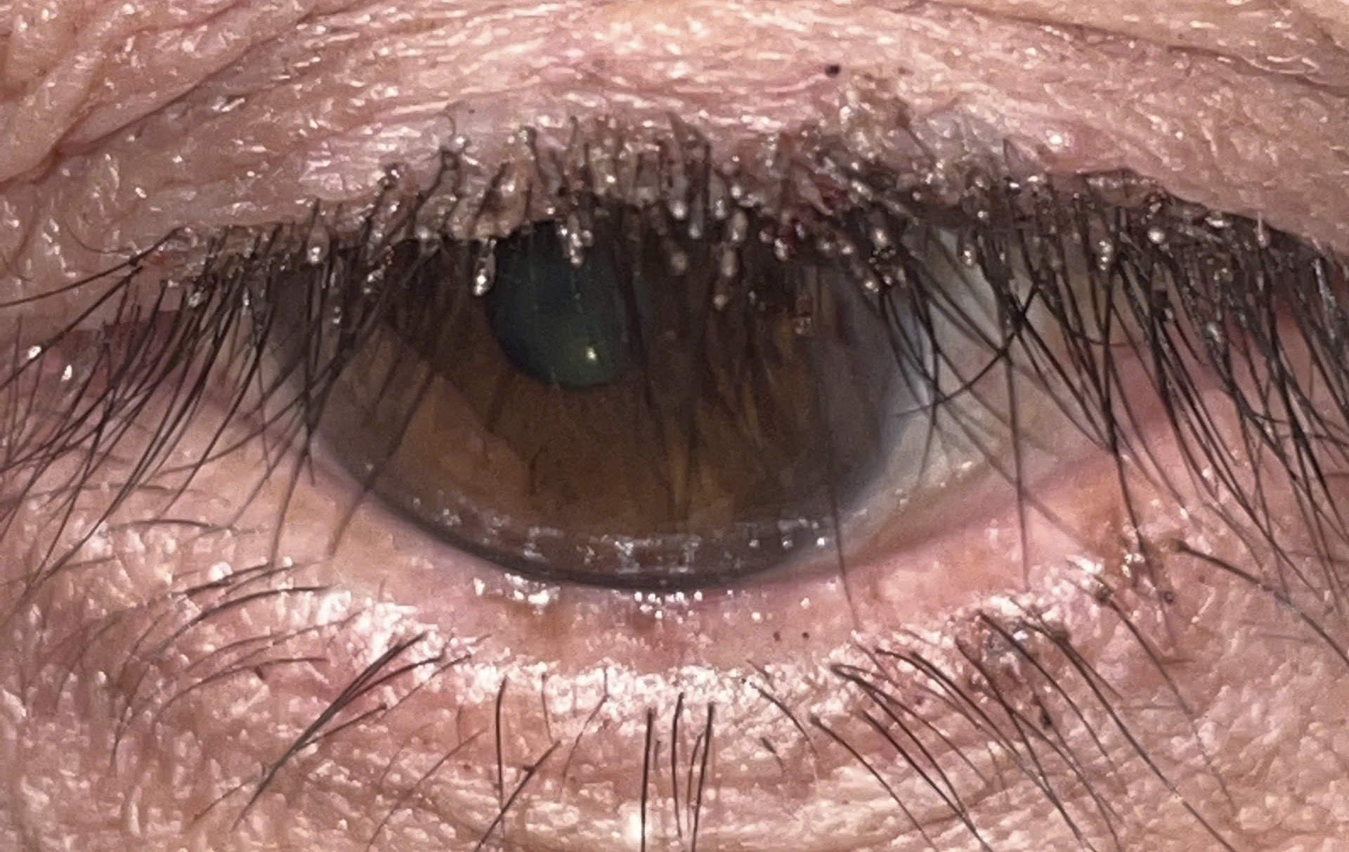 ran mu tren mi mat anh 1