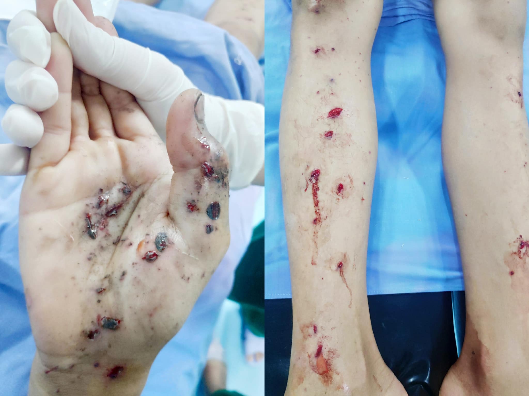 bị thương do pháo nổ ảnh 1 bi thuong do phao no anh 1