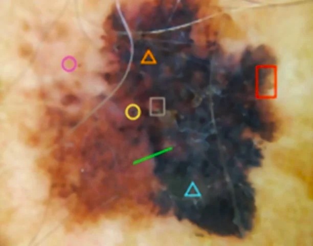 bieu hien ung thu da anh 1