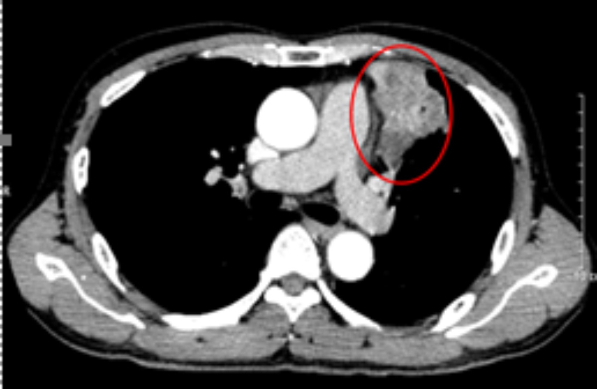 mac 2 loai ung thu anh 1