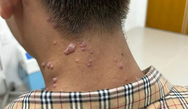 Thanh nien 17 tuoi o Dong Nai nghi mac dau mua khi hinh anh