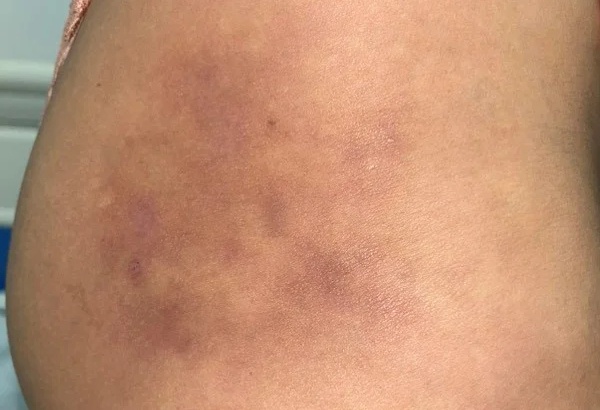 bien chung tiem filler anh 1