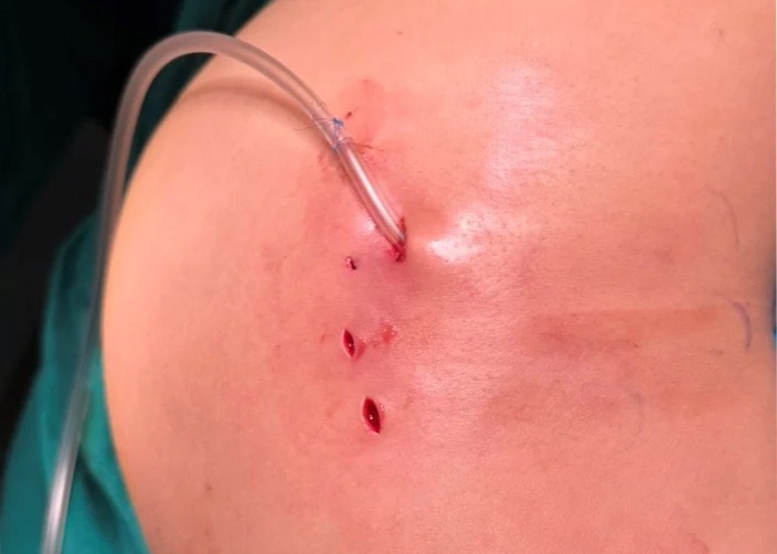 Ly do co gai nhap vien voi vung mong nhiem trung hinh anh