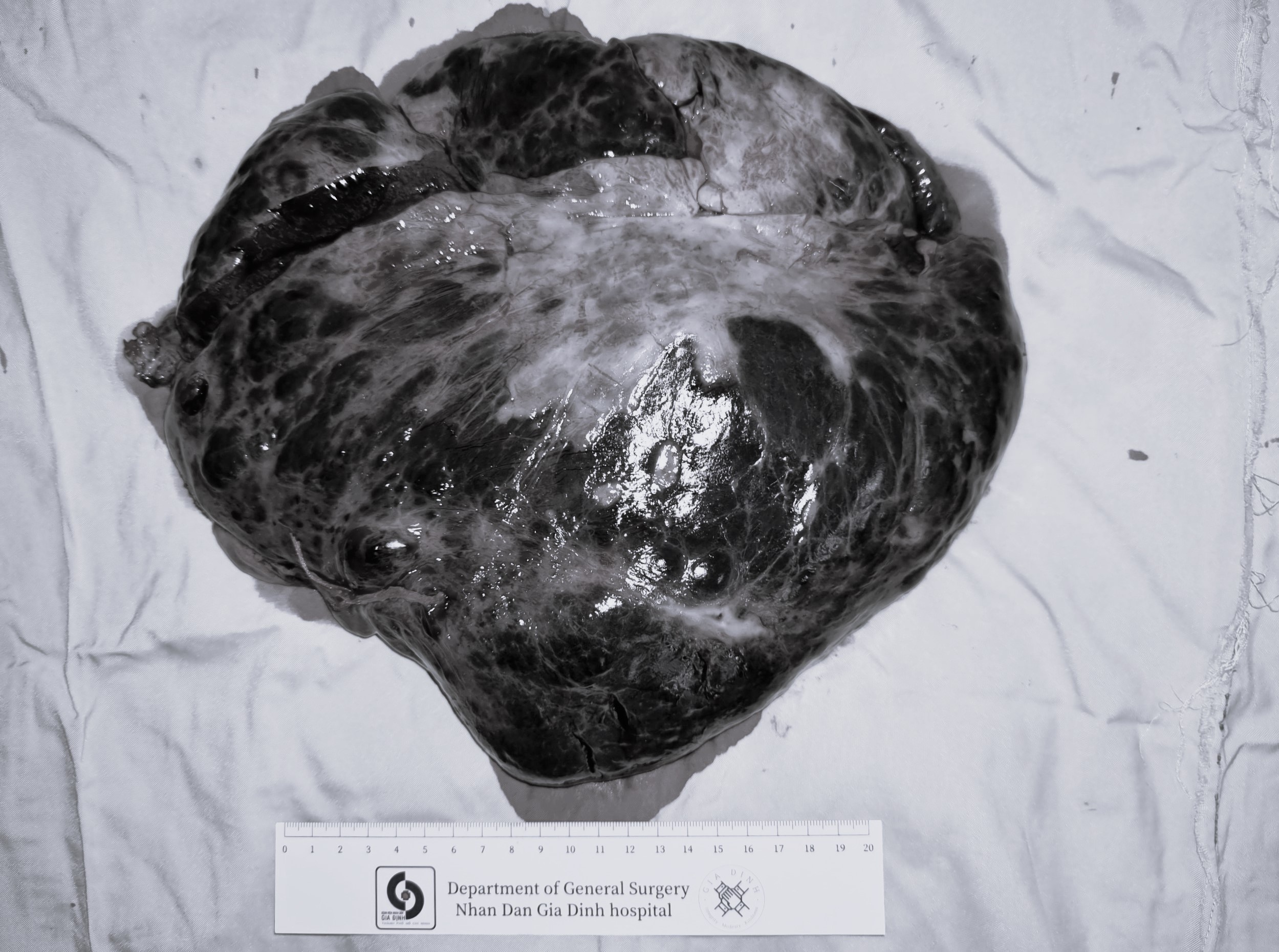 khoi u gan khong lo anh 1