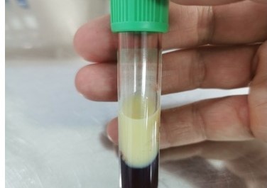 Mau mau ky la cua benh nhan viem tuy cap hinh anh