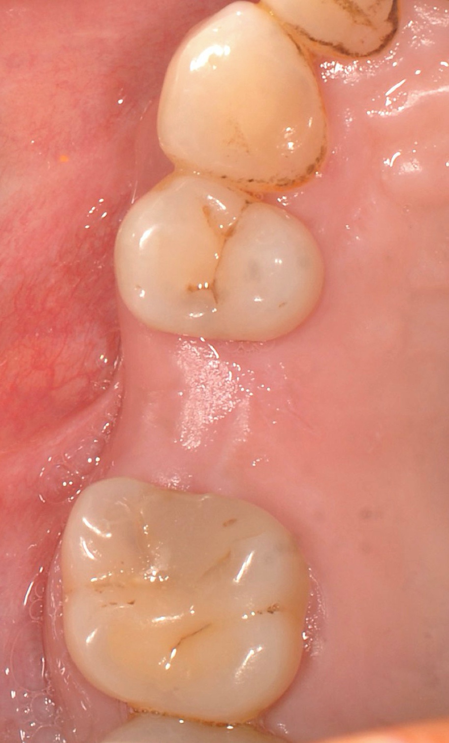 cay rang implant anh 1