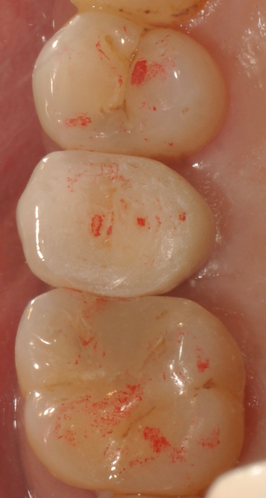 cay rang implant anh 2