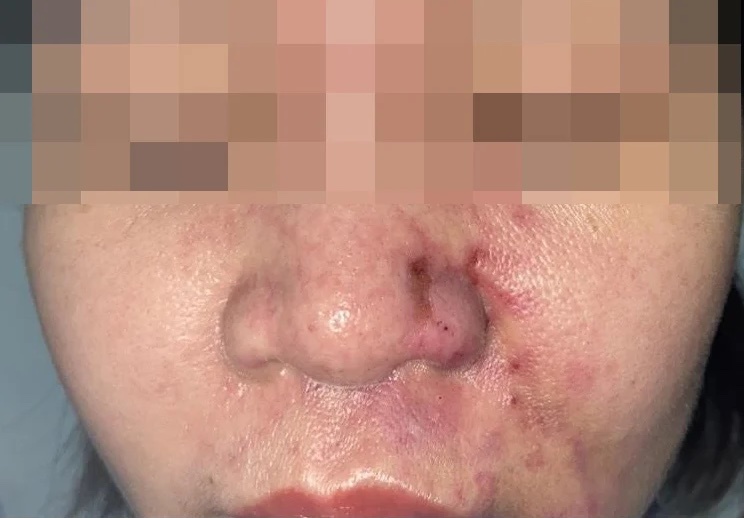 Nhap vien sau khi tiem filler tai spa cua nguoi quen hinh anh