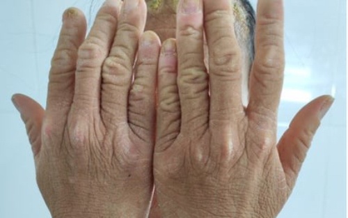 Can benh khien co gai sinh ra voi lop vay sung toan than hinh anh