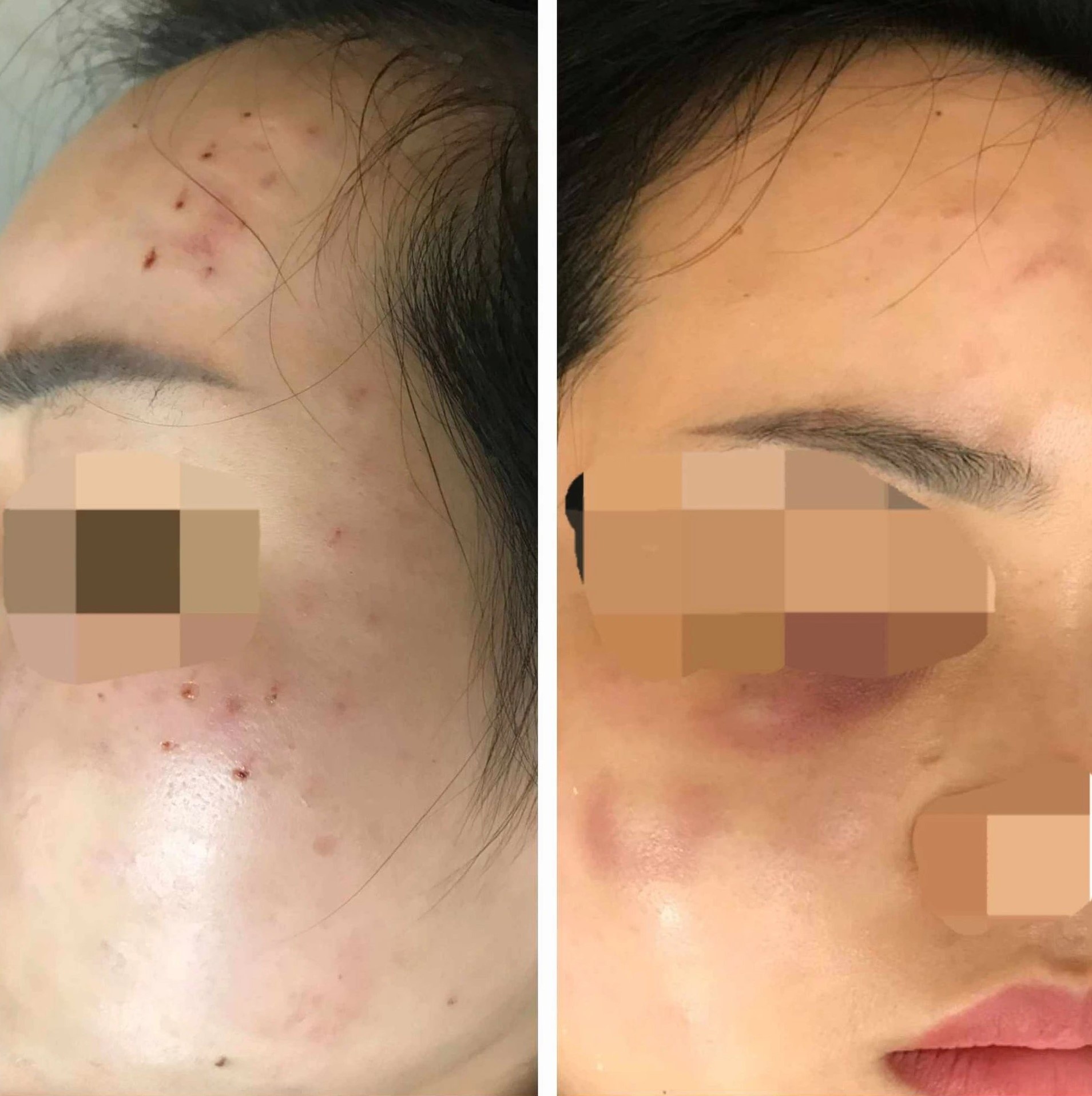 bien chung sau tiem meso anh 1