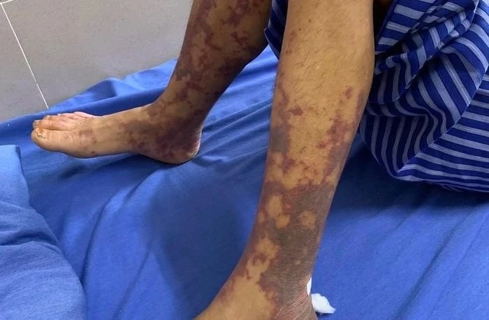 Mac benh nguy hiem do an nem chua, nem nam o quan bia hinh anh