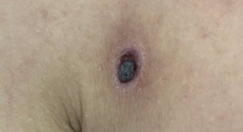 Vet loet nho o nguc khien nguoi dan ong suy da tang hinh anh