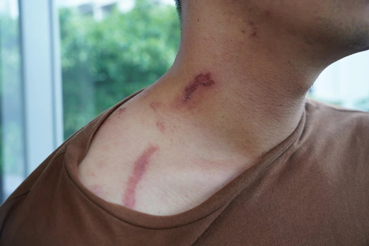 Cach kien ba khoang gay vet thuong cho nguoi hinh anh
