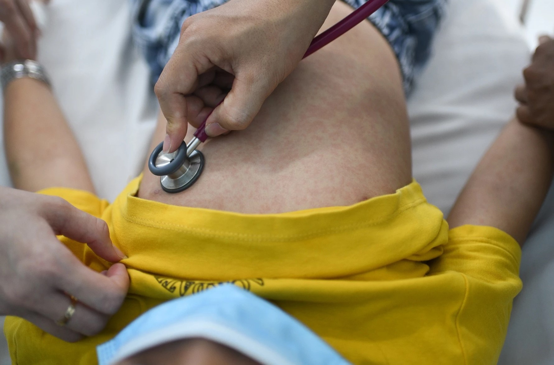 Dak Lak xuat hien o dich soi hinh anh