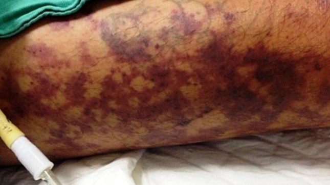 Mac lien cau lon sau khi an banh uot thit heo hinh anh