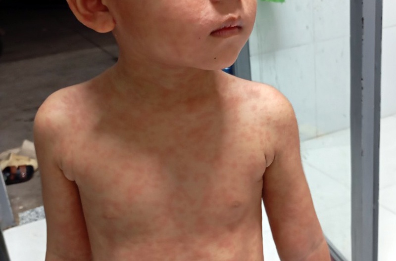 Dong Nai chuan bi trien khai chien dich tiem vaccine soi hinh anh