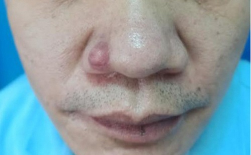 Khoi u nho canh bao benh ung thu hiem gap hinh anh