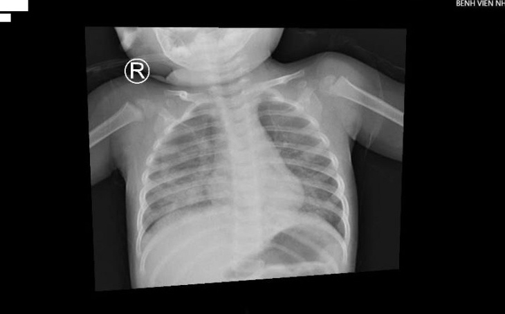 Be trai 1 tuoi o TP.HCM nhap vien vi hit dau de thap den hinh anh