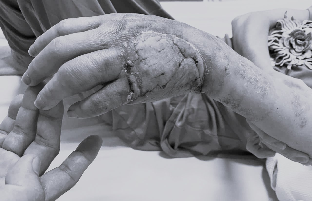 Suyt mat ban tay chi vi chu quan voi not phong nho hinh anh