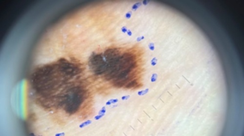 Quy tac de nho giup phat hien som ung thu da hinh anh