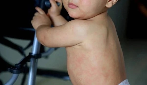 Nhom tre co nguy co mac benh soi cao nhat hinh anh