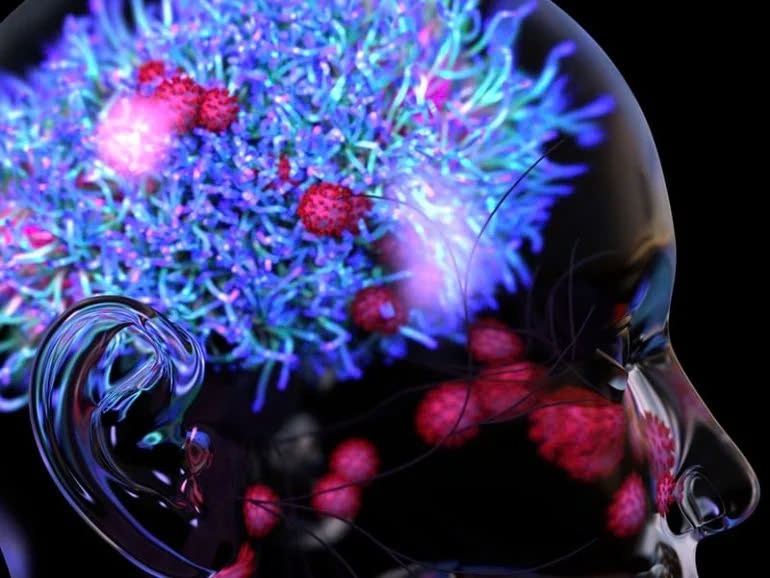 Cac bieu hien thuong gap cua viem nao hinh anh