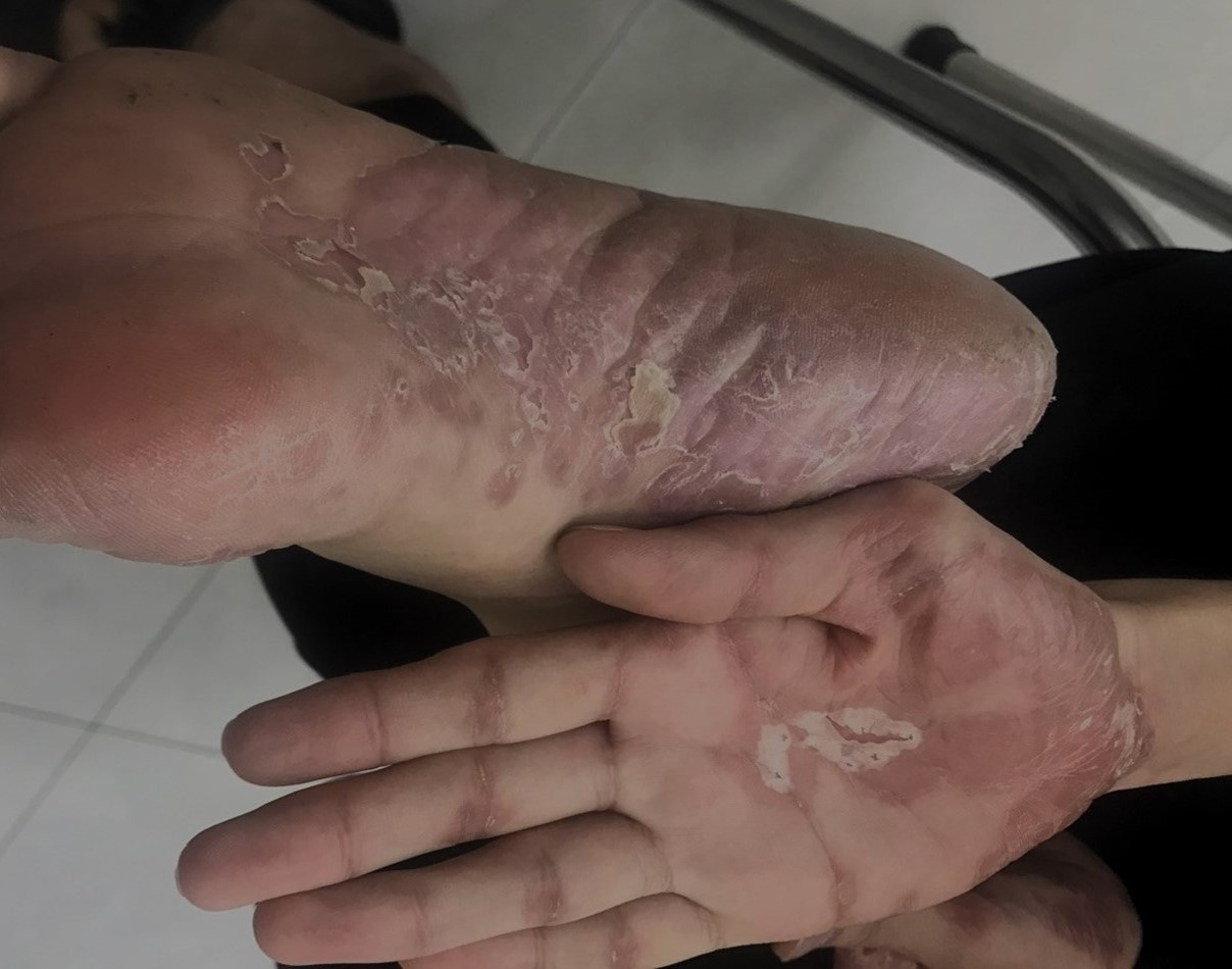 benh giang mai anh 1