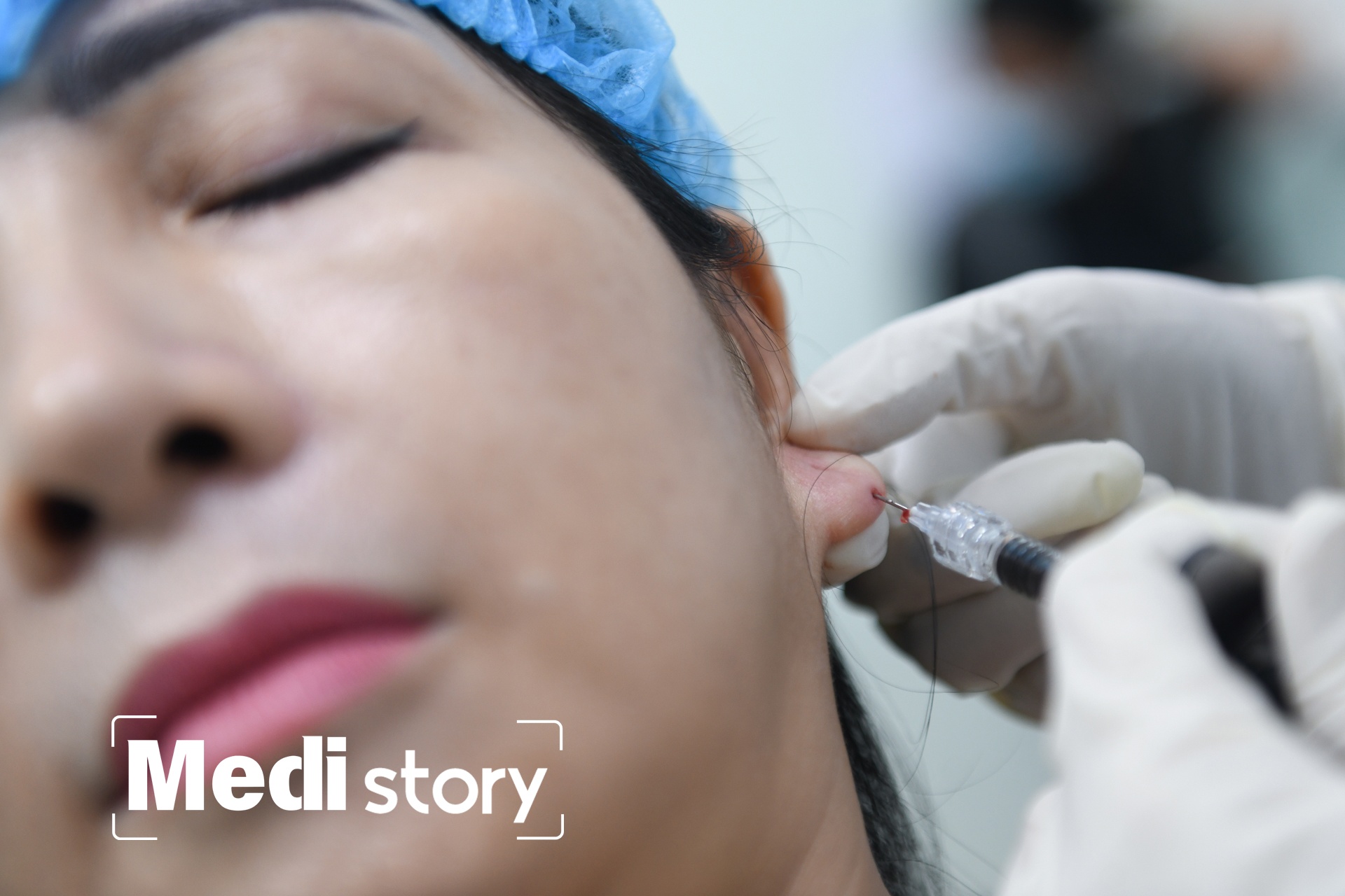 Can canh quy trinh tao hinh tai 'tai loc' tai TP.HCM hinh anh